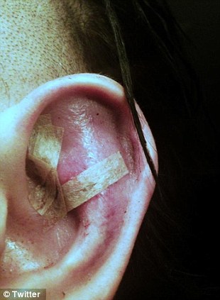 Marilyn Manson's Stiched Ear