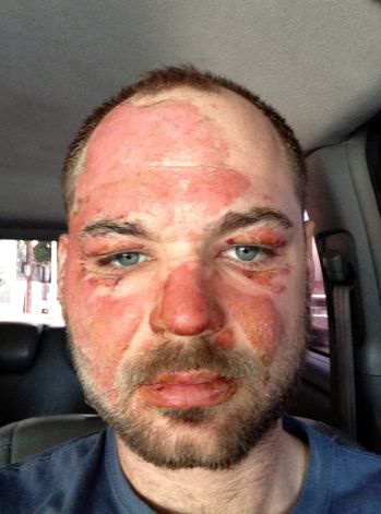 Close up of Magician Wayne Houchin's burnt Face